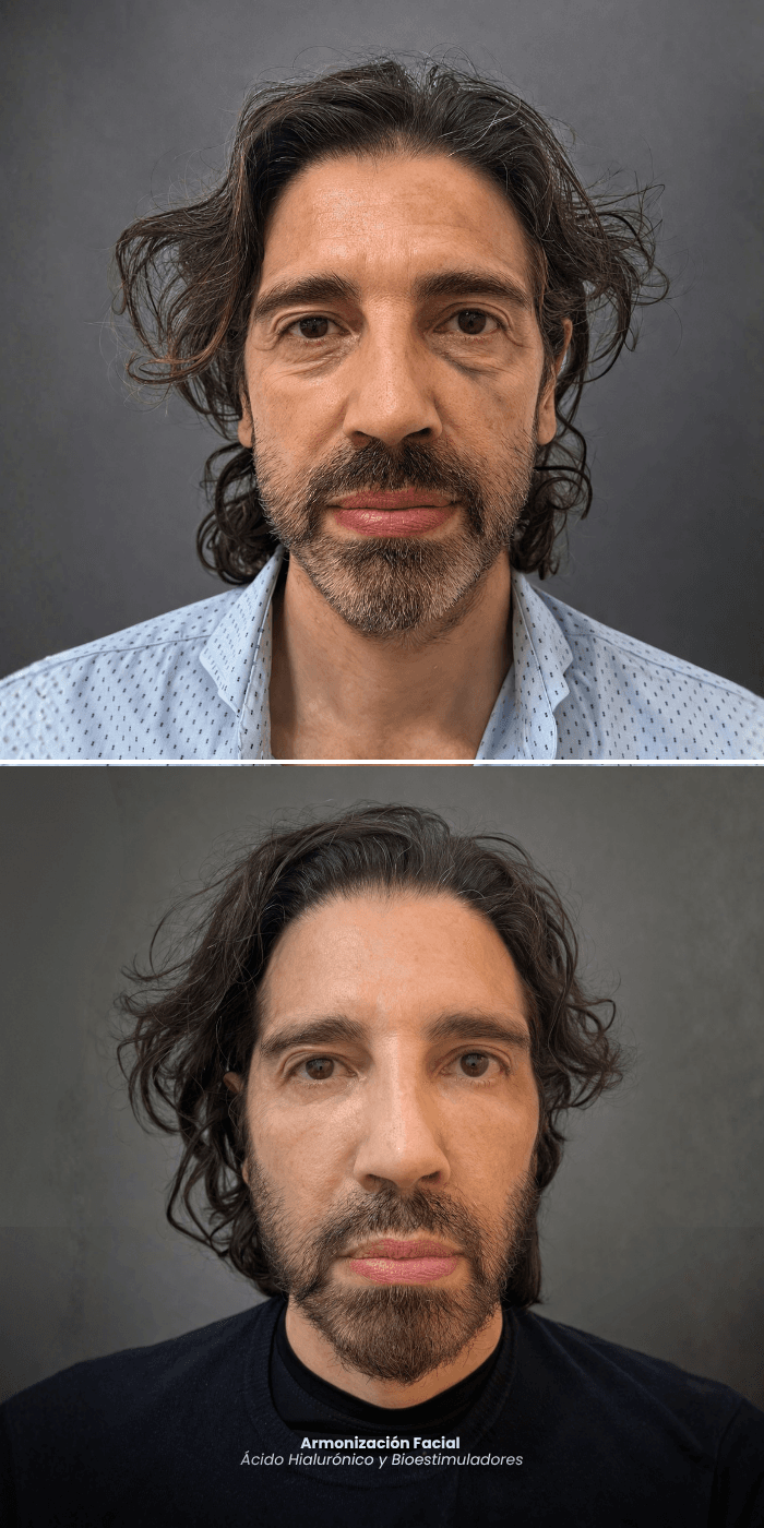 Armonización facial
